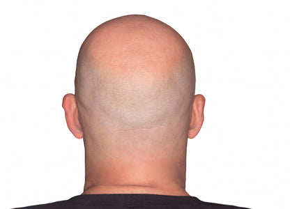 Rear view of a bald man's head and neck against a plain white background.